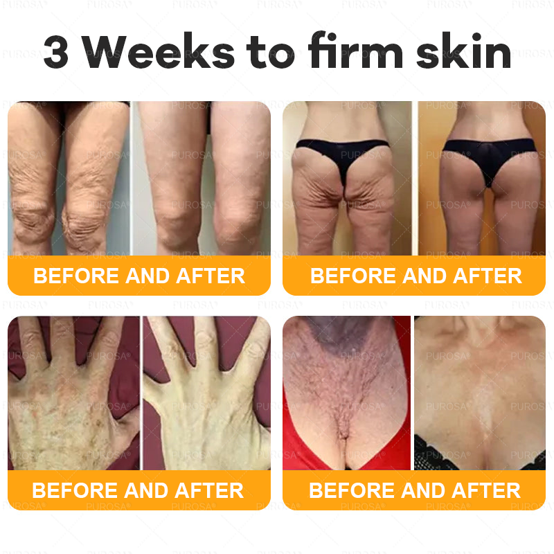 NATRAVOR® 𝘽𝙀𝙀 𝙑𝙀𝙉𝙊𝙈 𝙎𝙠𝙞𝙣 𝙍𝙚𝙨𝙩𝙤𝙧𝙖𝙩𝙞𝙤𝙣 𝘾𝙧𝙚𝙖𝙢 –🌸 Anti-aging,Hydrating, Skin Repair, Even Tone, Acne and Dark Spot Treatment, Wart and Mole Removal, Psoriasis Relief