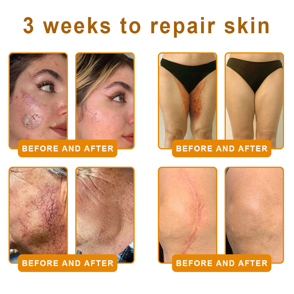 NATRAVOR® 𝘽𝙀𝙀 𝙑𝙀𝙉𝙊𝙈 𝙎𝙠𝙞𝙣 𝙍𝙚𝙨𝙩𝙤𝙧𝙖𝙩𝙞𝙤𝙣 𝘾𝙧𝙚𝙖𝙢 –🌸 Anti-aging,Hydrating, Skin Repair, Even Tone, Acne and Dark Spot Treatment, Wart and Mole Removal, Psoriasis Relief
