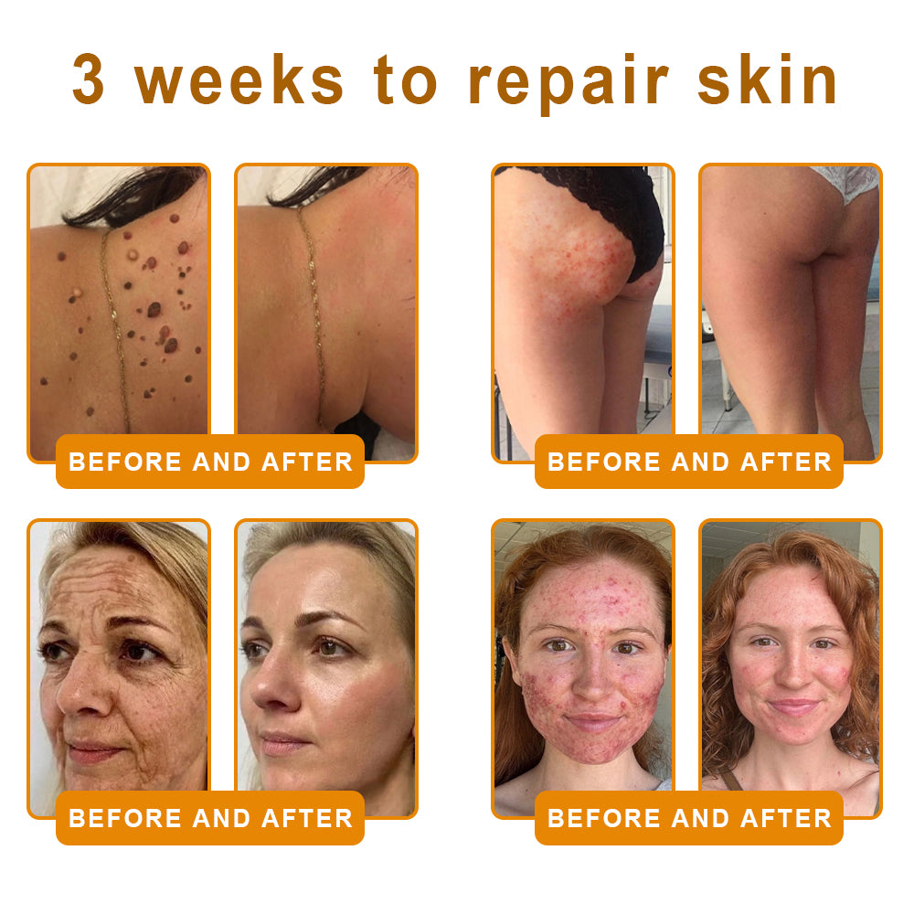 NATRAVOR® 𝘽𝙀𝙀 𝙑𝙀𝙉𝙊𝙈 𝙎𝙠𝙞𝙣 𝙍𝙚𝙨𝙩𝙤𝙧𝙖𝙩𝙞𝙤𝙣 𝘾𝙧𝙚𝙖𝙢 –🌸 Anti-aging,Hydrating, Skin Repair, Even Tone, Acne and Dark Spot Treatment, Wart and Mole Removal, Psoriasis Relief