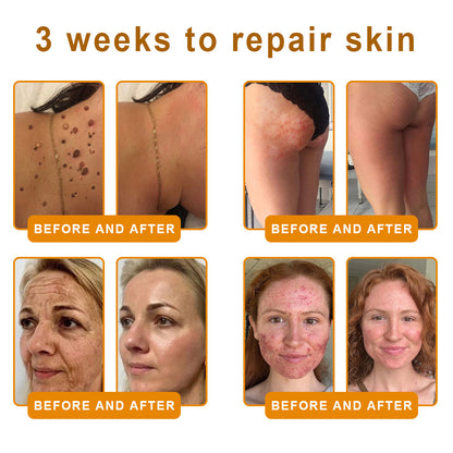 NATRAVOR® 𝘽𝙀𝙀 𝙑𝙀𝙉𝙊𝙈 𝙎𝙠𝙞𝙣 𝙍𝙚𝙨𝙩𝙤𝙧𝙖𝙩𝙞𝙤𝙣 𝘾𝙧𝙚𝙖𝙢 –🌸 Anti-aging,Hydrating, Skin Repair, Even Tone, Acne and Dark Spot Treatment, Wart and Mole Removal, Psoriasis Relief