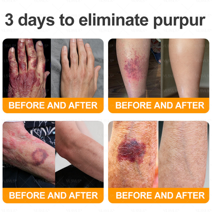 NATRAVOR® 𝘽𝙀𝙀 𝙑𝙀𝙉𝙊𝙈 𝙎𝙠𝙞𝙣 𝙍𝙚𝙨𝙩𝙤𝙧𝙖𝙩𝙞𝙤𝙣 𝘾𝙧𝙚𝙖𝙢 –🌸 Anti-aging,Hydrating, Skin Repair, Even Tone, Acne and Dark Spot Treatment, Wart and Mole Removal, Psoriasis Relief